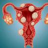 子宫肌瘤 子宫肌瘤是什么