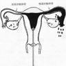 输卵管造影 什么是输卵管造影检查