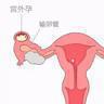 宫外怀孕初期症状 宫外孕症状早期