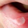 口腔溃疡的症状是什么