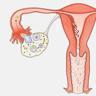 卵巢囊肿分类 卵巢囊肿分类有哪些