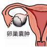 卵巢囊肿的症状 卵巢囊肿有什么症状